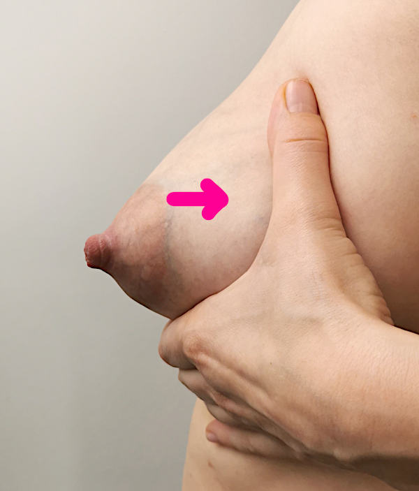 Die Brust einer Frau mit angelegter Hand in der Seitenansicht. Ein Pfeil zeigt von der Brust zur Körpermitte hin.